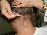 shepherd method head lice